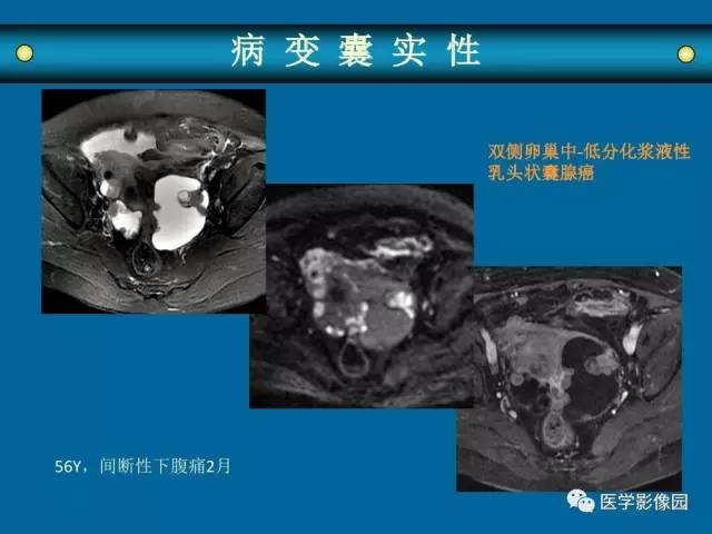【PPT】女性盆腔肿瘤的MR成像技术与诊断思路