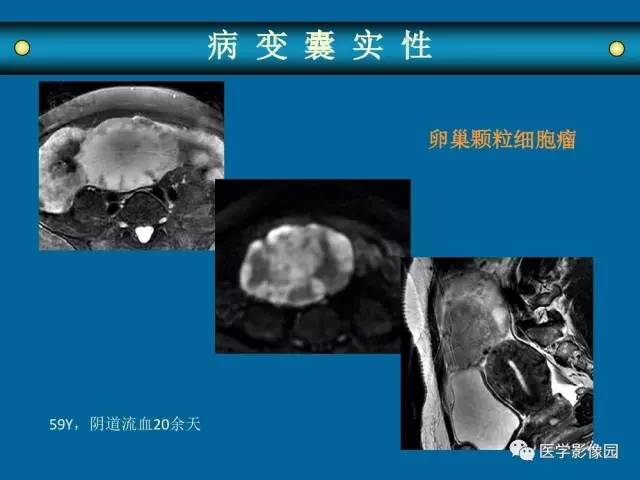 【PPT】女性盆腔肿瘤的MR成像技术与诊断思路