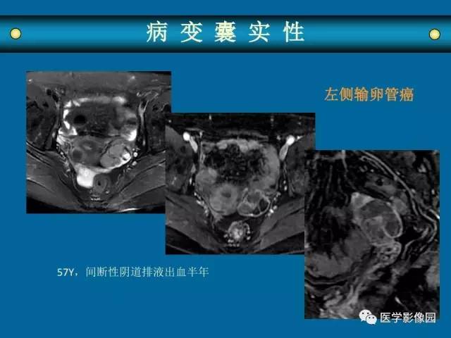 【PPT】女性盆腔肿瘤的MR成像技术与诊断思路