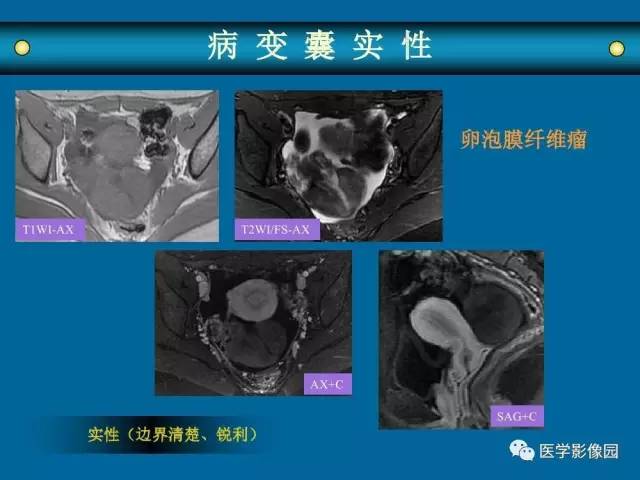 【PPT】女性盆腔肿瘤的MR成像技术与诊断思路