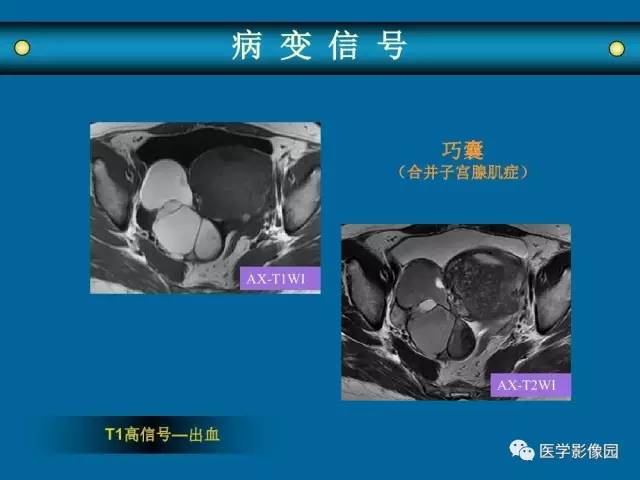【PPT】女性盆腔肿瘤的MR成像技术与诊断思路