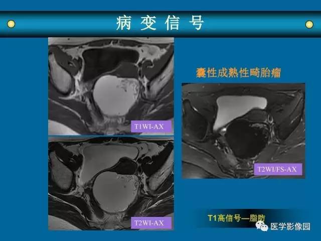 【PPT】女性盆腔肿瘤的MR成像技术与诊断思路
