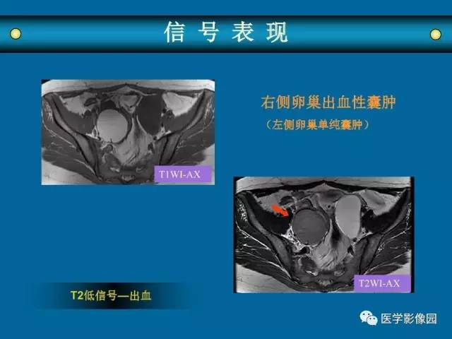 【PPT】女性盆腔肿瘤的MR成像技术与诊断思路