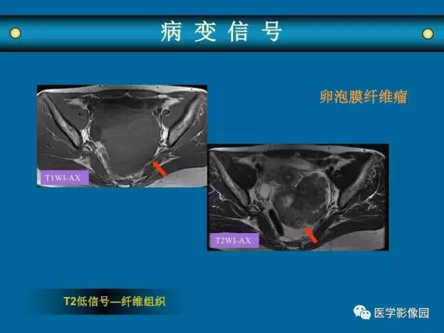 【PPT】女性盆腔肿瘤的MR成像技术与诊断思路