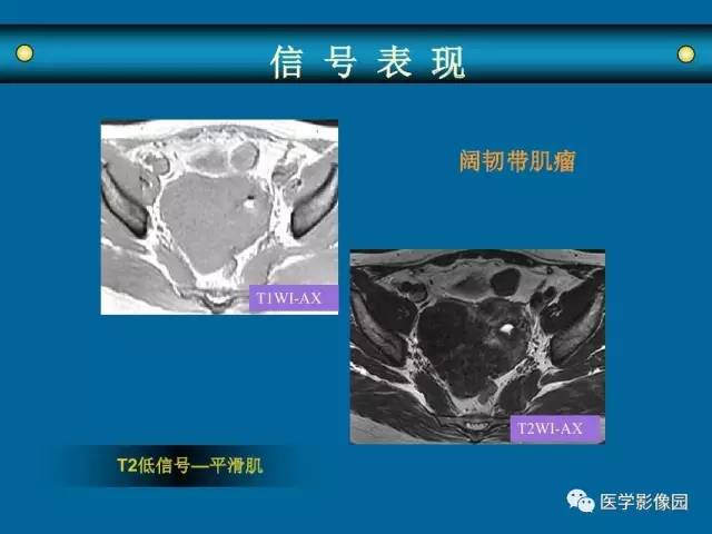 【PPT】女性盆腔肿瘤的MR成像技术与诊断思路