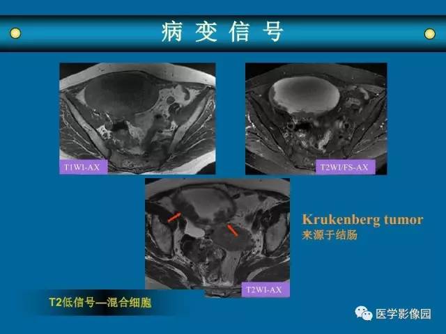 【PPT】女性盆腔肿瘤的MR成像技术与诊断思路