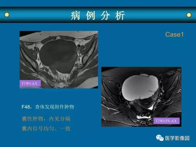 【PPT】女性盆腔肿瘤的MR成像技术与诊断思路