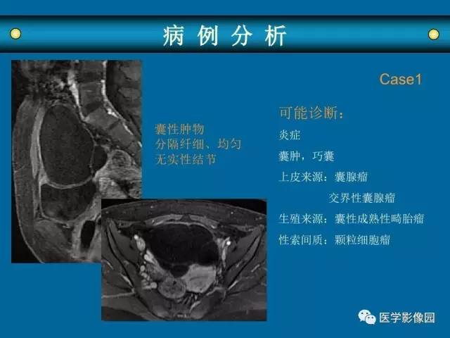 【PPT】女性盆腔肿瘤的MR成像技术与诊断思路