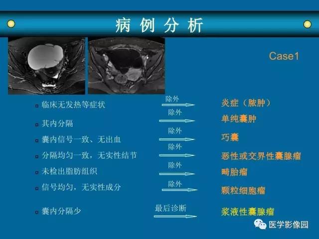 【PPT】女性盆腔肿瘤的MR成像技术与诊断思路