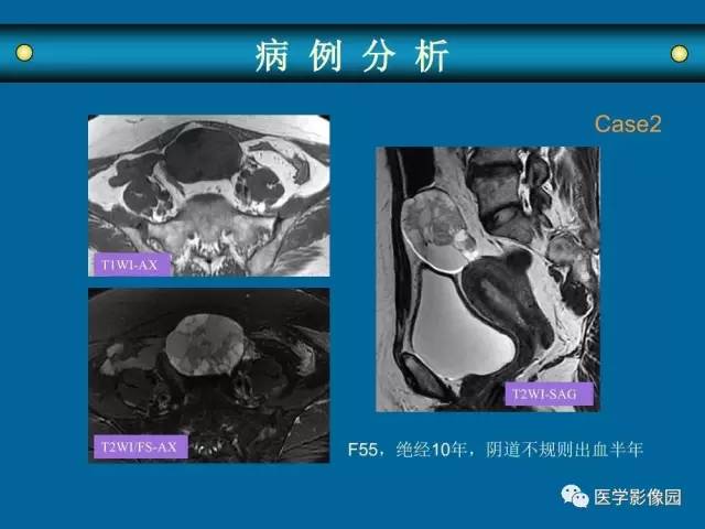 【PPT】女性盆腔肿瘤的MR成像技术与诊断思路