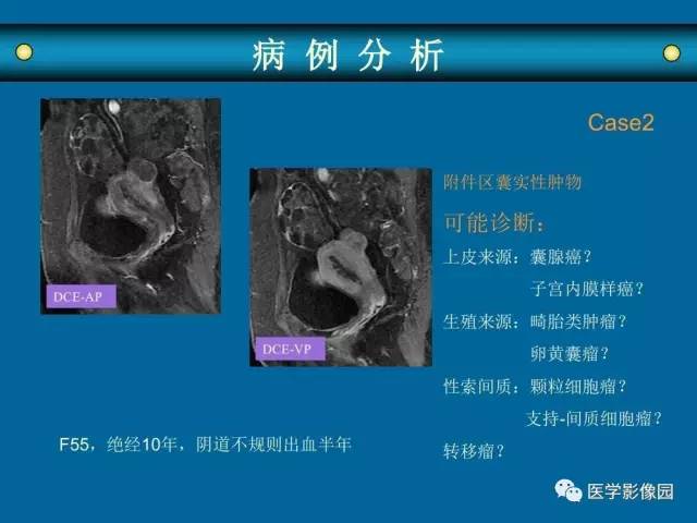 【PPT】女性盆腔肿瘤的MR成像技术与诊断思路