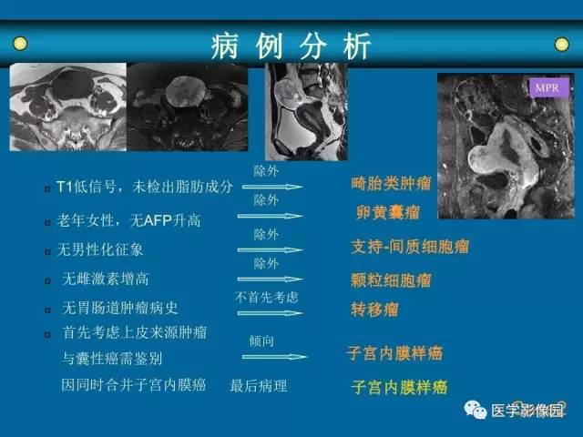 【PPT】女性盆腔肿瘤的MR成像技术与诊断思路