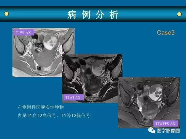 【PPT】女性盆腔肿瘤的MR成像技术与诊断思路