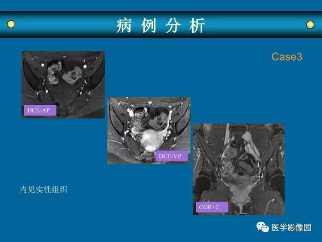 【PPT】女性盆腔肿瘤的MR成像技术与诊断思路