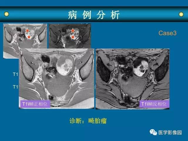 【PPT】女性盆腔肿瘤的MR成像技术与诊断思路