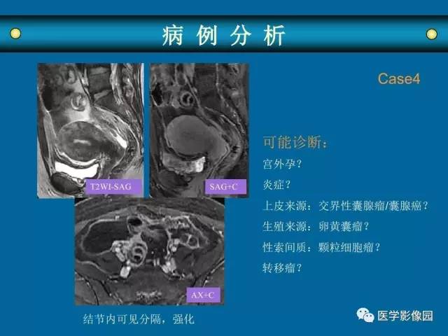 【PPT】女性盆腔肿瘤的MR成像技术与诊断思路