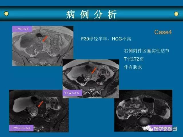 【PPT】女性盆腔肿瘤的MR成像技术与诊断思路