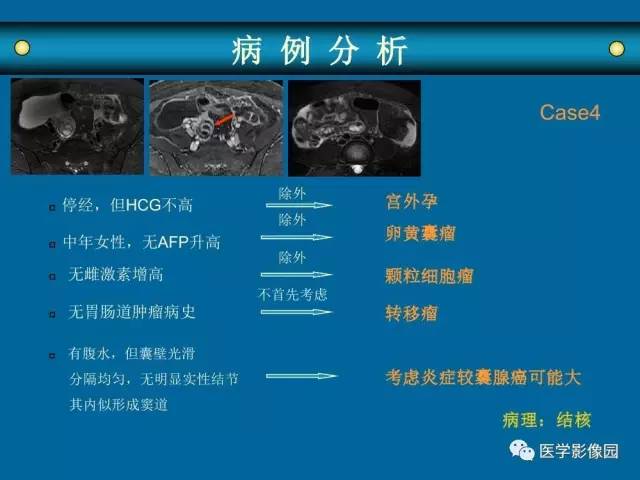 【PPT】女性盆腔肿瘤的MR成像技术与诊断思路