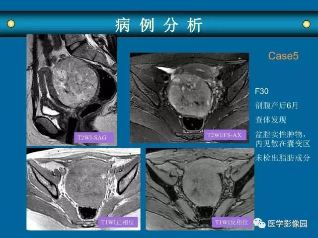 【PPT】女性盆腔肿瘤的MR成像技术与诊断思路