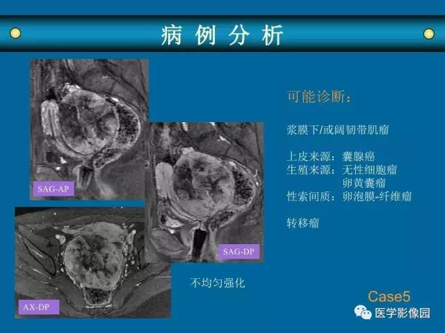 【PPT】女性盆腔肿瘤的MR成像技术与诊断思路