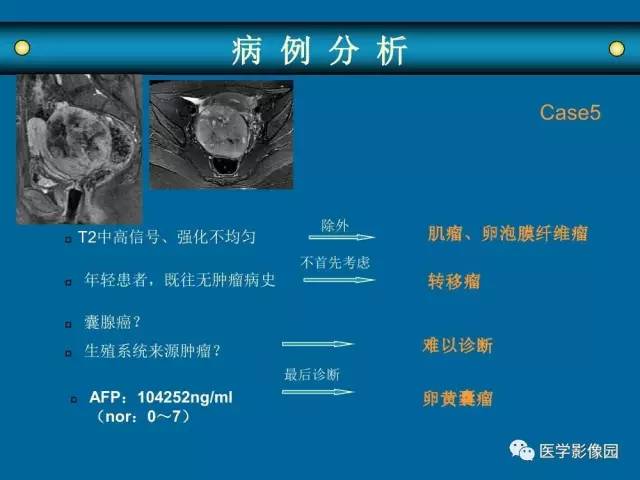 【PPT】女性盆腔肿瘤的MR成像技术与诊断思路