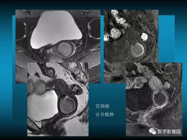 【PPT】女性盆腔肿瘤的MR成像技术与诊断思路