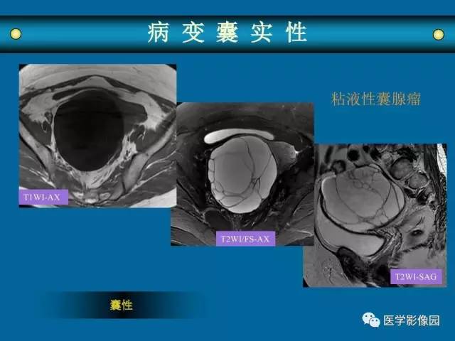 【PPT】女性盆腔肿瘤的MR成像技术与诊断思路