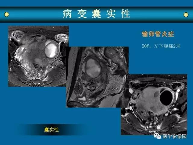 【PPT】女性盆腔肿瘤的MR成像技术与诊断思路