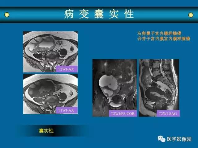 【PPT】女性盆腔肿瘤的MR成像技术与诊断思路