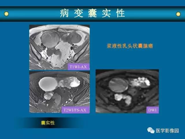 【PPT】女性盆腔肿瘤的MR成像技术与诊断思路
