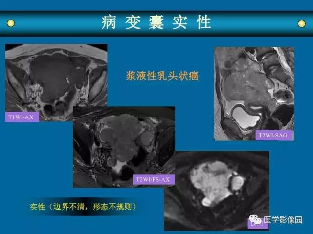 【PPT】女性盆腔肿瘤的MR成像技术与诊断思路