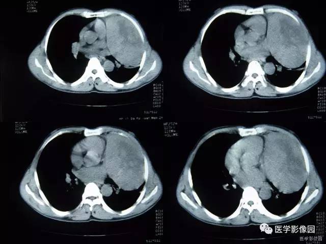 【病例】胸腺类癌1例CT影像表现 【病例】胸腺类癌1例CT影像表现