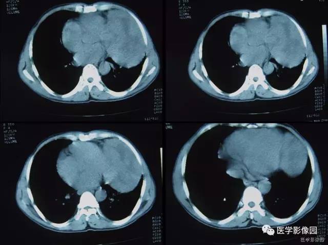 【病例】胸腺类癌1例CT影像表现 【病例】胸腺类癌1例CT影像表现