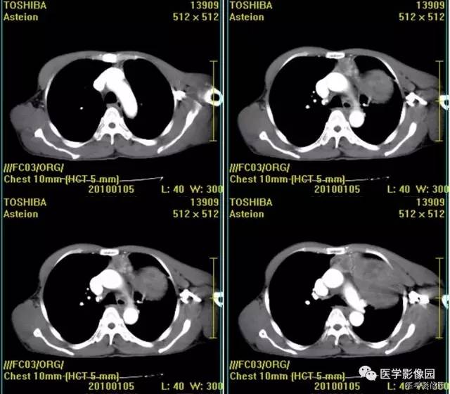 【病例】胸腺类癌1例CT影像表现 【病例】胸腺类癌1例CT影像表现