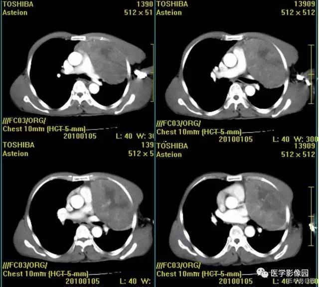 【病例】胸腺类癌1例CT影像表现 【病例】胸腺类癌1例CT影像表现