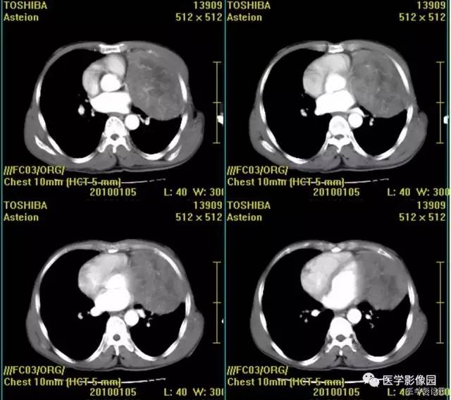 【病例】胸腺类癌1例CT影像表现 【病例】胸腺类癌1例CT影像表现