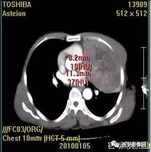 【病例】胸腺类癌1例CT影像表现 【病例】胸腺类癌1例CT影像表现