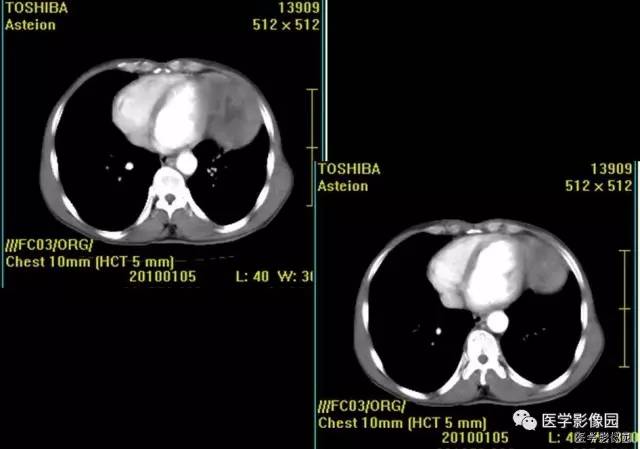 【病例】胸腺类癌1例CT影像表现 【病例】胸腺类癌1例CT影像表现