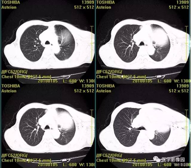 【病例】胸腺类癌1例CT影像表现 【病例】胸腺类癌1例CT影像表现