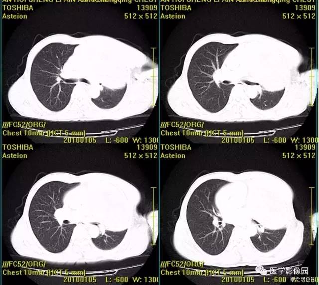 【病例】胸腺类癌1例CT影像表现 【病例】胸腺类癌1例CT影像表现