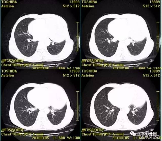 【病例】胸腺类癌1例CT影像表现 【病例】胸腺类癌1例CT影像表现