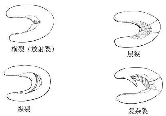 典型征象分析之双后交叉韧带征 典型征象分析之双后交叉韧带征