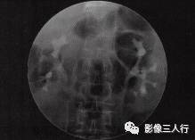 【病例】肾脏炎性肌纤维母细胞瘤1例CT影像表现分析 【病例】肾脏炎性肌纤维母细胞瘤1例CT影像表现分析