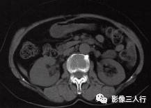 【病例】肾脏炎性肌纤维母细胞瘤1例CT影像表现分析 【病例】肾脏炎性肌纤维母细胞瘤1例CT影像表现分析