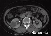【病例】肾脏炎性肌纤维母细胞瘤1例CT影像表现分析 【病例】肾脏炎性肌纤维母细胞瘤1例CT影像表现分析