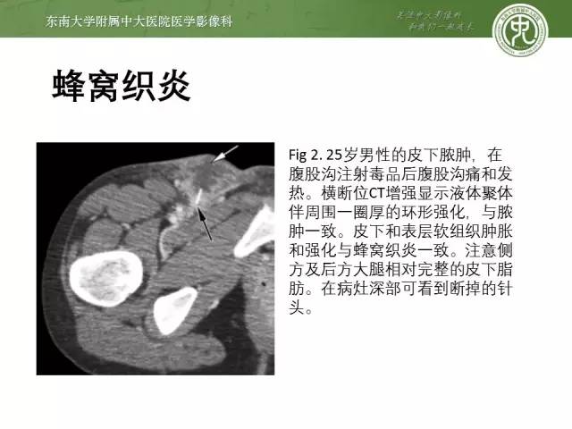 【PPT】软组织感染的影像学表现：从蜂窝织炎到坏死性筋膜炎