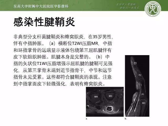 【PPT】软组织感染的影像学表现：从蜂窝织炎到坏死性筋膜炎