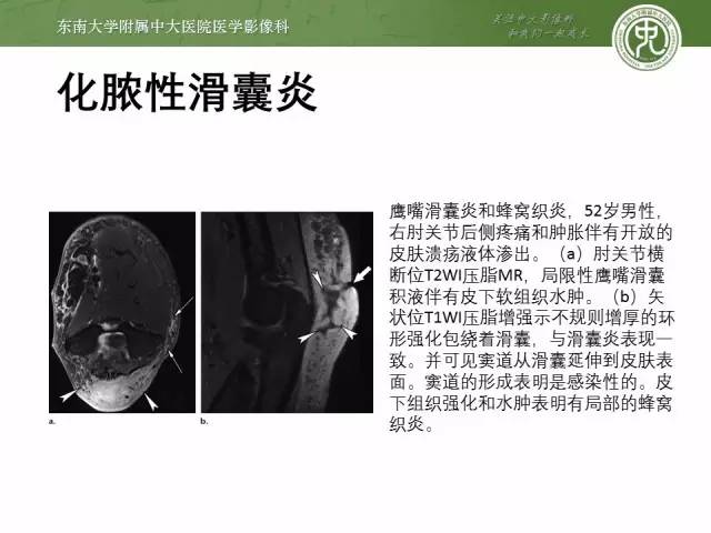 【PPT】软组织感染的影像学表现：从蜂窝织炎到坏死性筋膜炎