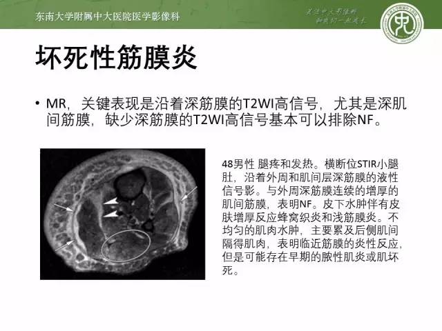 【PPT】软组织感染的影像学表现：从蜂窝织炎到坏死性筋膜炎