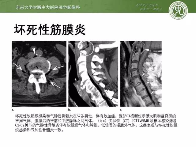 【PPT】软组织感染的影像学表现：从蜂窝织炎到坏死性筋膜炎